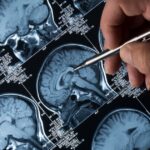 Double-Blind Study Supports Medical Marijuana for Epilepsy